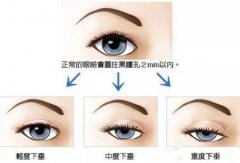 洪星杓双眼皮修复洪氏CFS 广州紫馨洪星杓修复做鼻修